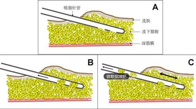 半永久化妆是微整形吗？两者有什么区别？